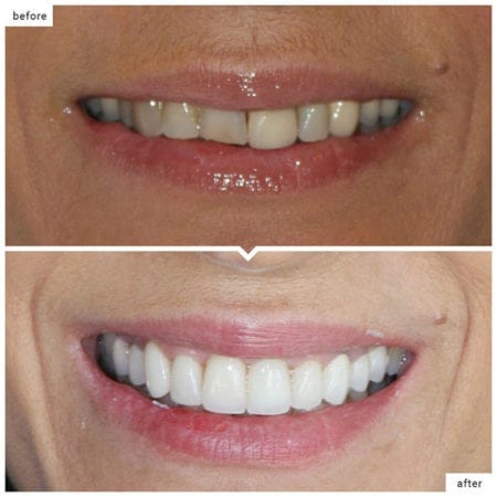top photo of a damaged tooth, bottom photo is the tooth fixed with a porcelain crown