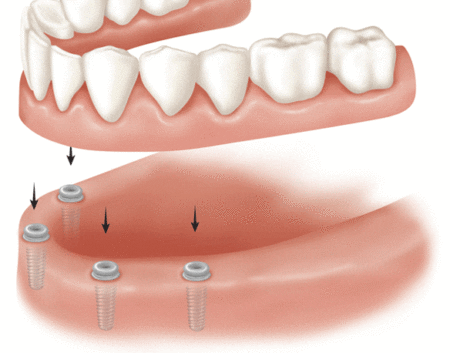 Close up of snap on dentures