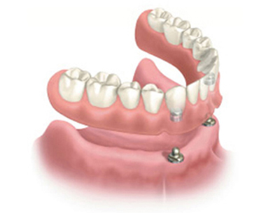 Implant overdenture - snap-on denture with the denture hovering above the implants