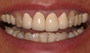 Person smiling showing their top and bottom teeth, shows 11 bottom teeth and 13 top teeth.