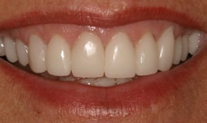 Person smiling and showing their top front teeth, showing 11 teeth