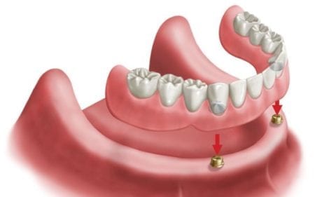 drawing of a lower denture being placed over two implants toward the front of a lower jaw