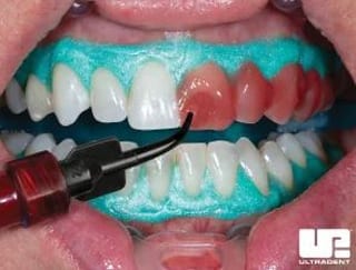 Not Zoom but Opalescence Boost in-office whitening applied to a patient's teeth