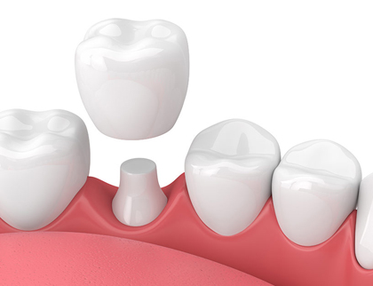 Diagram of a same-day-crown hovering over a molar tooth