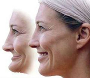 Before and after facial collapse.