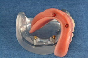 snap on dentures