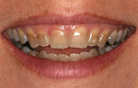 Teeth with tetracycline stains