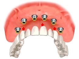 Illustration of implant supported dentures